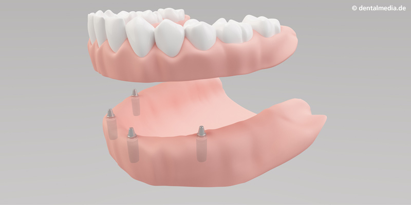 Sehr viele oder alle Zähne fehlen. Mit mehreren Implantaten haben Teil- oder Vollprothesen, herausnehmbar oder festsitzend, einen festen Halt.